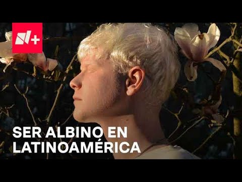 Albinismo: ¿Qué es y cuáles son sus causas? - Por las Mañanas