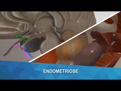 Março amarelo: mês de conscientização sobre a endometriose