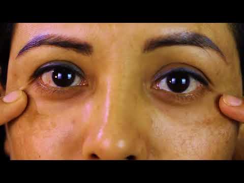 Corrección de BLEFAROPLASTIA mal hecha con LIPOINJERTO  Dr PERCY NEVADO Cirugía Plástica