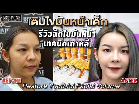 รีวิวเติมไขมันหน้าเด็กหลังทำด