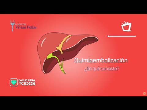 Quimioembolización para el cáncer de hígado || SALUD PARA TODOS