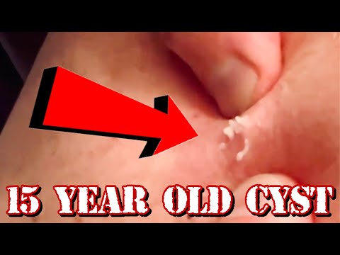 Draining a 15 YEAR OLD Cyst | HARD POP | Very Satisfying Release - #TheBubbaArmy