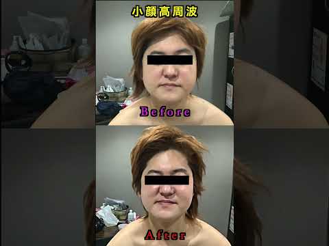 【脱毛・フェイシャル】 あなたも小顔、リフトアップの効果を体験しませんか? #shorts #美容 #beautyface #小顔 #リフトアップ#makeupvideo #スキンケア