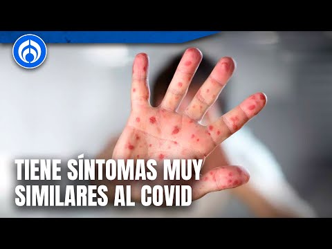 UNAM alerta por el aumento de casos de sarampión en el país