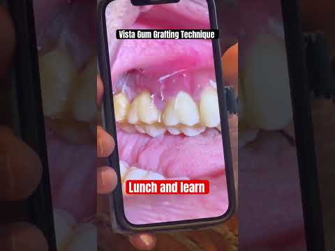 Lunch and Learn | Dental Gum Graft | Ly Nguyen DDS #life #dentist #gumsurgery #gum recession