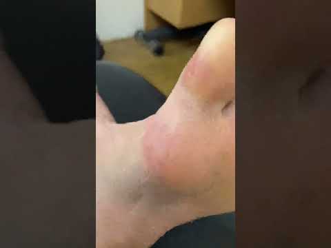 Shocking Big Toe Callus Removal: See the Transformation! #FootCare #CallusRemoval