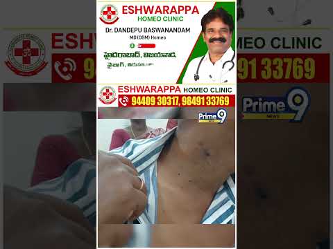 Eshwarappa Homeo <strong>Clinic</strong> : కిడ్నీ ఫెయిల్.. సీరం క్రియేటిన్ పెరిగింది | Prime9 News