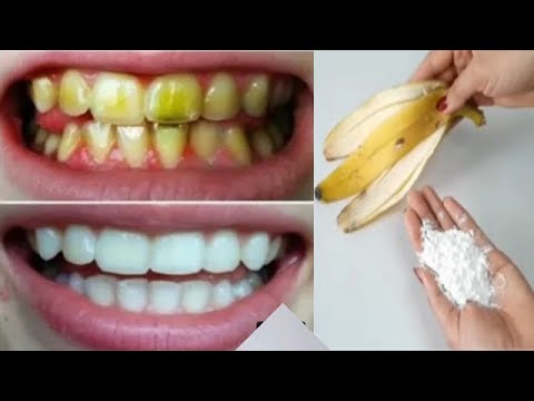 How to REMOVE DENTAL PLAQUE AT HOME IN 2 MINUTES WITHOUT WASTING YOUR MONE AT THE DENTIST