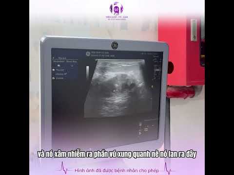 Liệu uống thuốc nam có chữa khỏi ung thư vú?