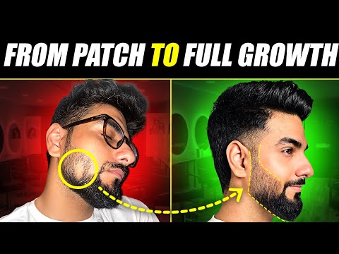 This is How I Treated a DANGEROUS Beard Patch? 😰 Alopecia Areata Treatment | The Gabru Life