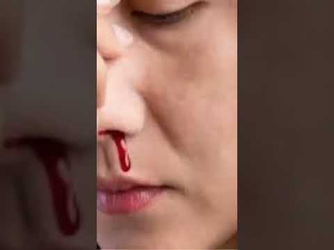 Sangrado Nasal-Vitaminas Que Te Hacen Falta Cuando Sangras Mucho De La Nariz-Hemorragia Nasal