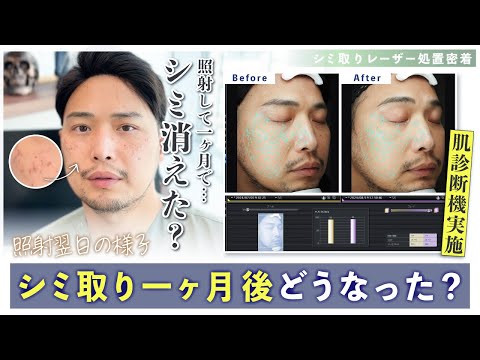 【肌改善】シミ取りしてどうなった？王 蘇医師のシミ取り後の経過を紹介【レーザー治療】王医師の肌改善の旅04 #肌質改善 #美容皮膚科 #ピコスポット