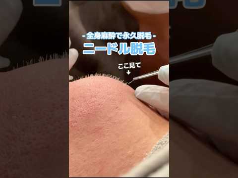 するする抜ける白髪👶🏻 #全身麻酔 #ニードル脱毛 #脱毛 #美容 #shorts