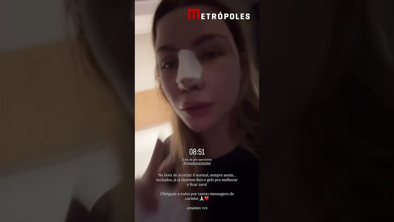 Fernando Zor e a namorada fazem rinoplastia juntos