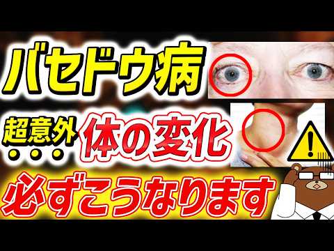 汗・食欲・動悸..知らないと必ず損する「バセドウ病」の意外な初期症状。甲状腺の機能はなぜ暴走するのか。眼球が飛び出る？更年期と間違える？予防法はあるのか。医師が完全解説。