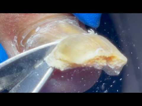 Onychomycosis Is Hard And Brittle, And Can Be Removed Instantly!【Pedicure Master Lin Jun】