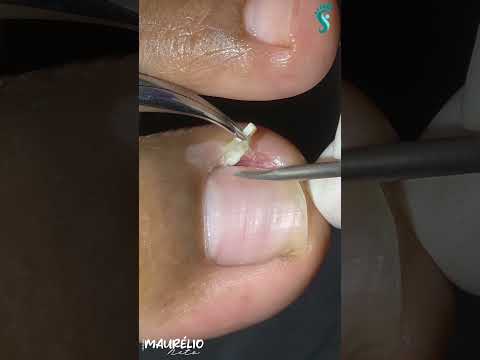 DÊ ADEUS À UNHA ENCRAVADA HOJE! #podologomaurelio #shorts