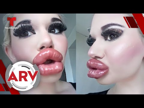 Barbie humana es operada para tener los labios más grandes del mundo | Al Rojo Vivo | Telemundo