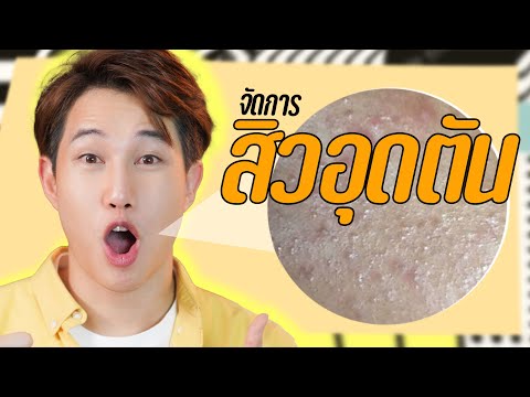 สิวอุดตัน-รักษายังไง-รักษาสิวด สิวอุดตัน-รักษายังไง-รักษาสิวด