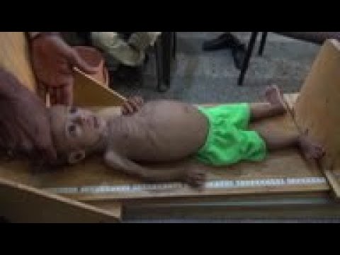 Hunger stalks Yemeni children as UN cuts programs