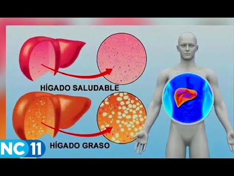 ¿Cómo identificar y tratar el hígado graso?