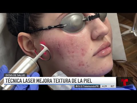 Terapia con laser puede mejorar la textura de la piel