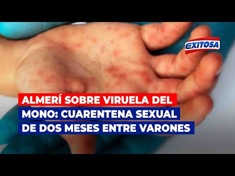 Almerí sobre viruela del mono: Cuarentena sexual de dos meses entre varones