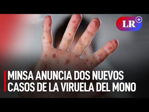 Minsa confirmó 2 nuevos casos de viruela del mono en Perú | #LR