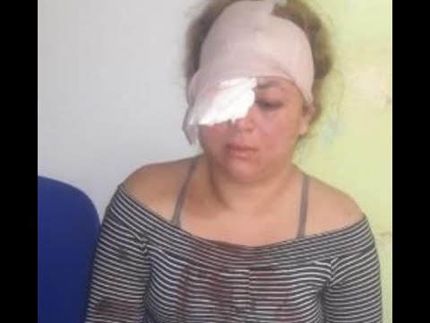Mujer agredida en el ojo sin justicia