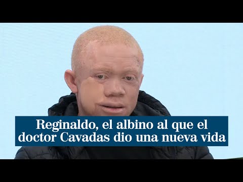Reginaldo, el albino al que el doctor Cavadas dio una nueva vida