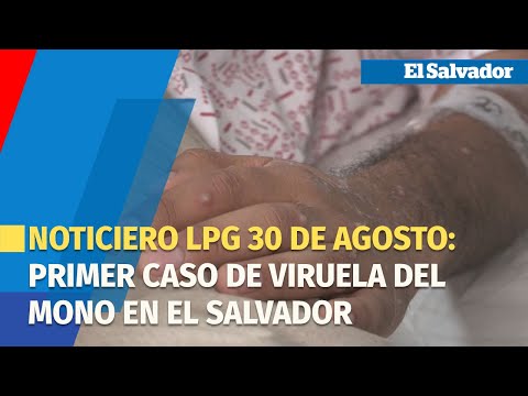 Noticiero LPG 30 de agosto: Confirman el primer caso de viruela del mono en El Salvador