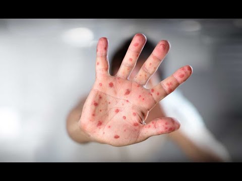 Minsa declara alerta epidemiológica por casos de sarampión y rubéola
