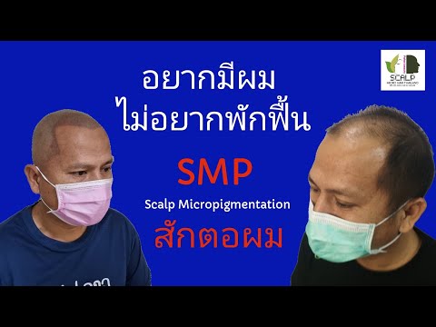 อยากมีผมแต่ไม่อยากพักฟื้นSMP