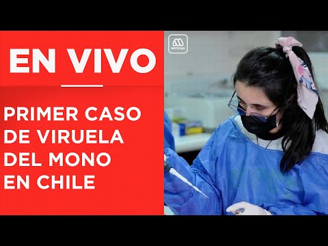 Se confirma caso de viruela del mono en Chile: Primer contagiado en Región Metropolitana