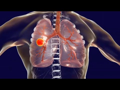 Abordaje del paciente con tuberculosis pulmonar