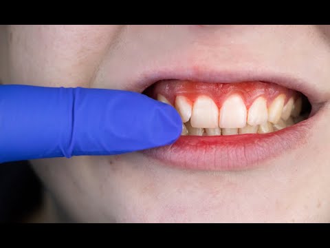 ¿Qué es la periodontitis