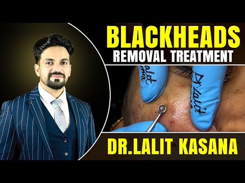 The BLACKHEAD Removal SECRET That's Changing Skincare Forever #blackheads