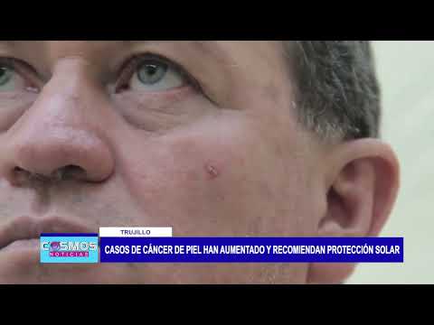 Trujillo: Casos de cáncer de piel han aumentado y recomiendan protección solar