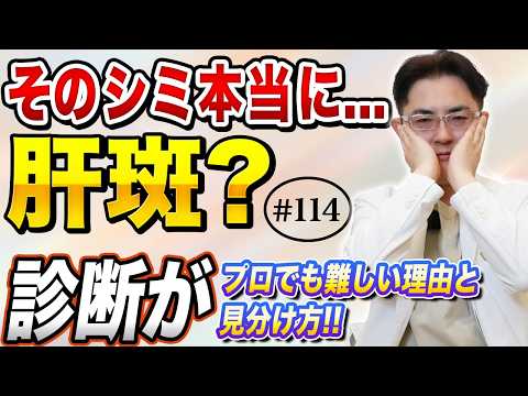 肝斑はめんどくさい怒りん坊の皮膚です。