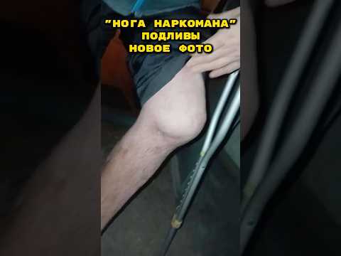 Нога "Подливы". До чего доводят наркотики!
