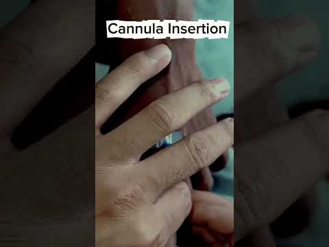 Cannula Insertion #nurse