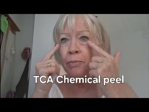 20% TCA peel