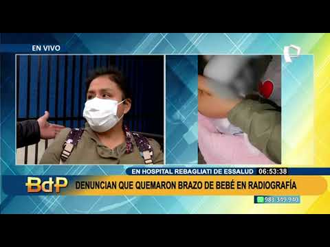 Madre denuncia a Hospital Rebagliati por quemaduras en todo el brazo de su bebé de 8 meses