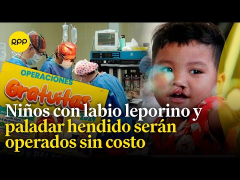 'Caritas felices 2024': Niños con labio leporino y paladar hendido podrán ser operados sin costo