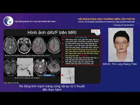 5. Rò động tĩnh mạch màng cứng nội sọ: từ lí thuyết đến thực hành (BS.CKI. Tôn Long Hoàng Thân)