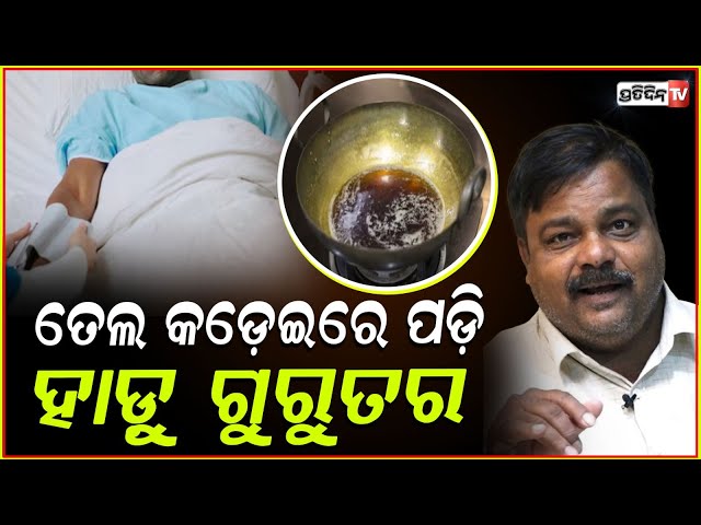 ତେଲ କଡେଇରେ ପଡ଼ି ଗୁରୁତର ହାସ୍ୟ ଅଭିନେତା ହାଡୁ ,ହସ୍ପିଟାଲ ରେ ଭର୍ତ୍ତି ! Odia actor Hadu in hospital
