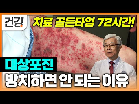 몸에서 쉬라는 마지막 경고, 치료시기 놓치면 진통제도 소용없는 신경통까지? | 대상포진 충격적인 진실 | 명의 | #EBS건강