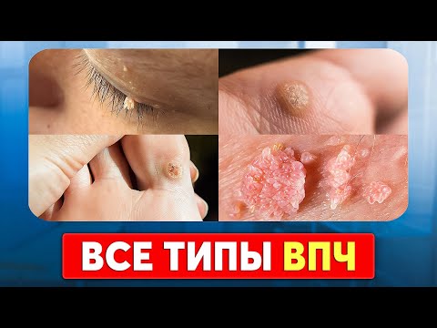 Самые ОПАСНЫЕ бородавки! Как избавиться от вируса папилломы человека?