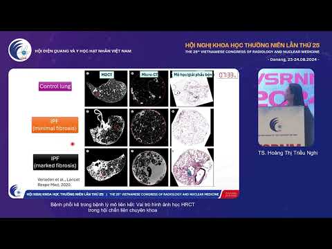 5. Bệnh phổi kẽ trong bệnh mô liên kết: Vai trò HRCT trong hội chẩn LCK (TS. Hoàng Thị Triều Nghi)