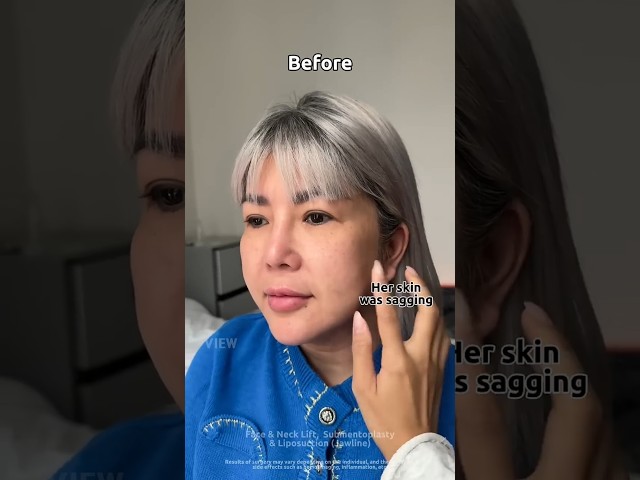 My mom before & after facelifting surgery in Korea #facelift #krisjenner #kardashian #fyp #viral